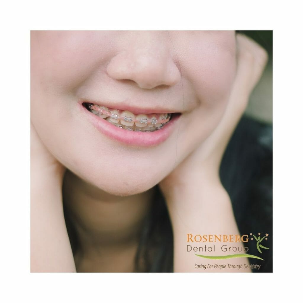 Do Braces Change Your Face? Blog Rosenberg Dental